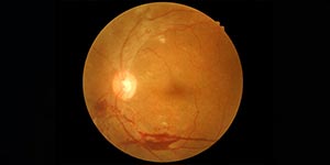 Branch Retinal Vein Occlusion (BRVO) Treatment Near Me in Connecticut