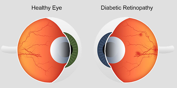 Diabetic Retinopathy Specialist Near Me in Hamden, Madison, Trumbull, New Haven, Norwalk, and Fairfield CT