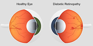 Diabetic Retinopathy Specialist Near Me in Hamden, Madison, Trumbull, New Haven, Norwalk, and Fairfield CT