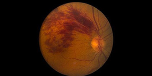 Branch Retinal Vein Occlusion (BRVO) Treatment Near Me in Connecticut