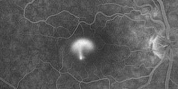 Central Serous Chorioretinopathy (CSCR) Treatment Near Me in Hamden CT, Norwalk CT, Trumbull CT, New Haven CT, Madison CT, and Fairfield CT