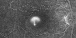 Central Serous Chorioretinopathy (CSCR) Treatment Near Me in Hamden CT, Norwalk CT, Trumbull CT, New Haven CT, Madison CT, and Fairfield CT