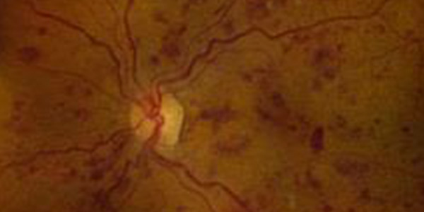 Diabetic Retinopathy Specialist Near Me in Hamden, Madison, Trumbull, New Haven, Norwalk, and Fairfield CT