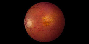 Age-Related Macular Degeneration (AMD) Near Me in Hamden, Madison, Trumbull, New Haven, Norwalk and Fairfield CT