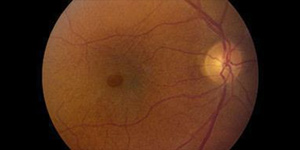 Macular Hole Treatment Near Me in Hamden, Norwalk, Trumbull, New Haven, Madison, and Fairfield CT 