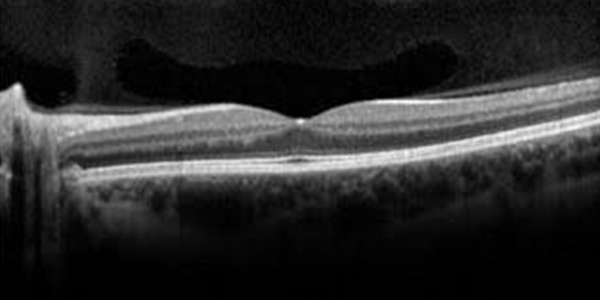 Optical Coherence Tomography (OCT) Scans Near Me in Hamden, Norwalk, Trumbull, New Haven, Madison, and Fairfield CT 