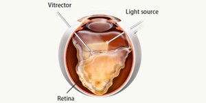 Pars Plana Vitrectomy Specialist Near Me in Hamden, Norwalk, Trumbull, New Haven, Madison, and Fairfield CT 