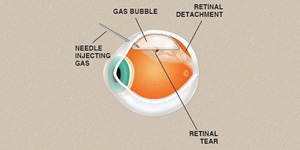 Pneumatic Retinopexy Specialist Near Me in Hamden, Norwalk, Trumbull, New Haven, Madison, and Fairfield CT 