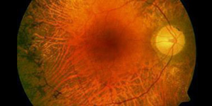 Inherited Retinal Disorders Treatment Specialist Near Me in Connecticut