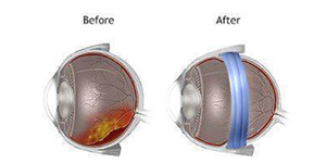 Scleral Buckling Specialist Near Me in Hamden, Norwalk, Trumbull, New Haven, Madison, and Fairfield CT 